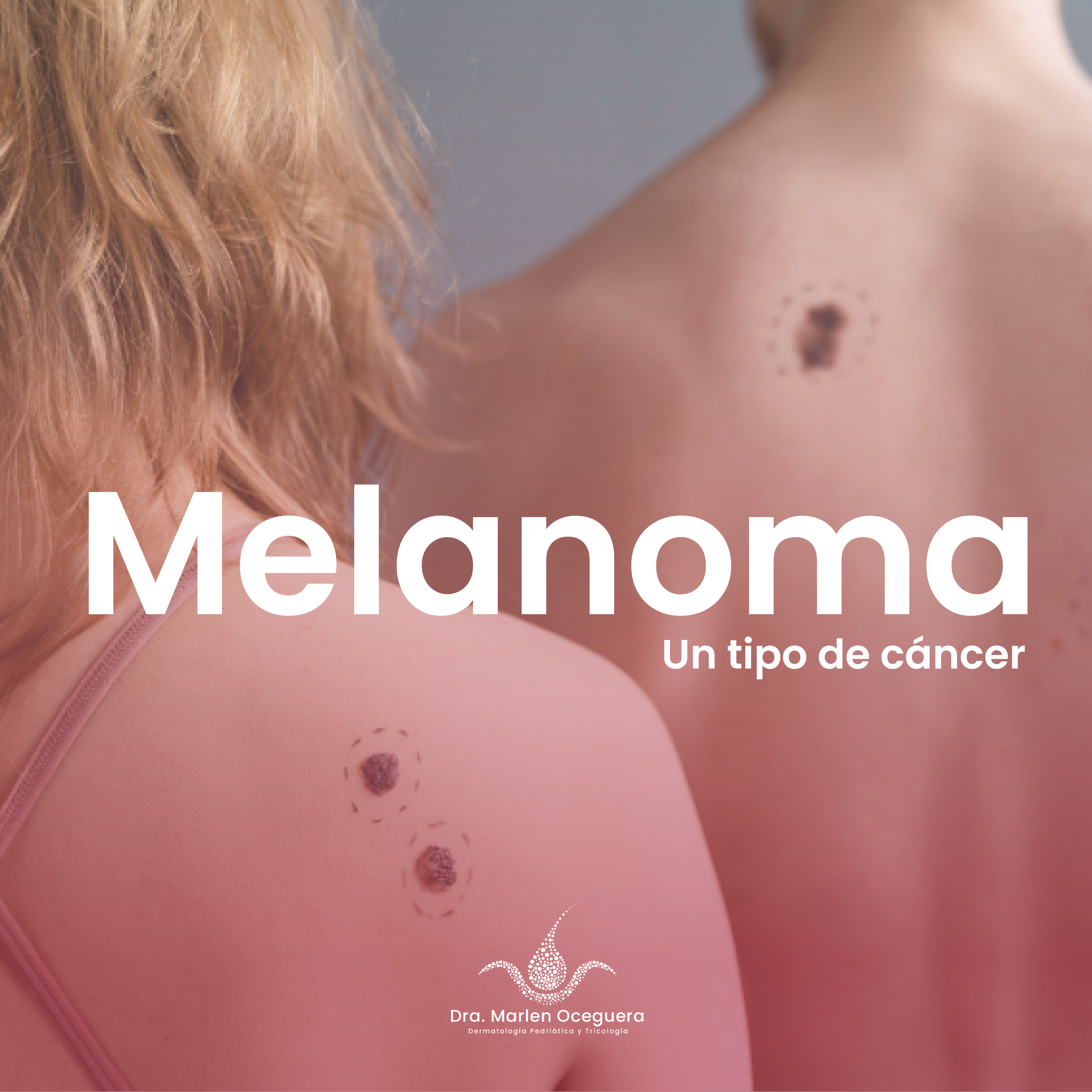 POST MARLEN melanoma_Mesa de trabajo 1 copia 2